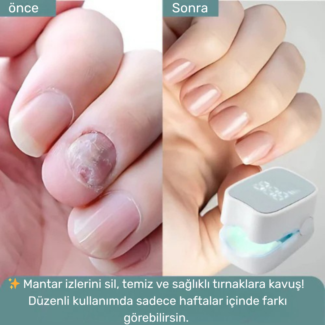 Lunexa™  Tırnak Mantarı Lazer Cihazı