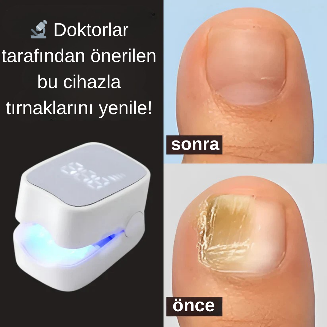 Lunexa™  Tırnak Mantarı Lazer Cihazı