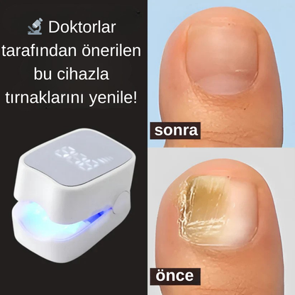Lunexa™  Tırnak Mantarı Lazer Cihazı